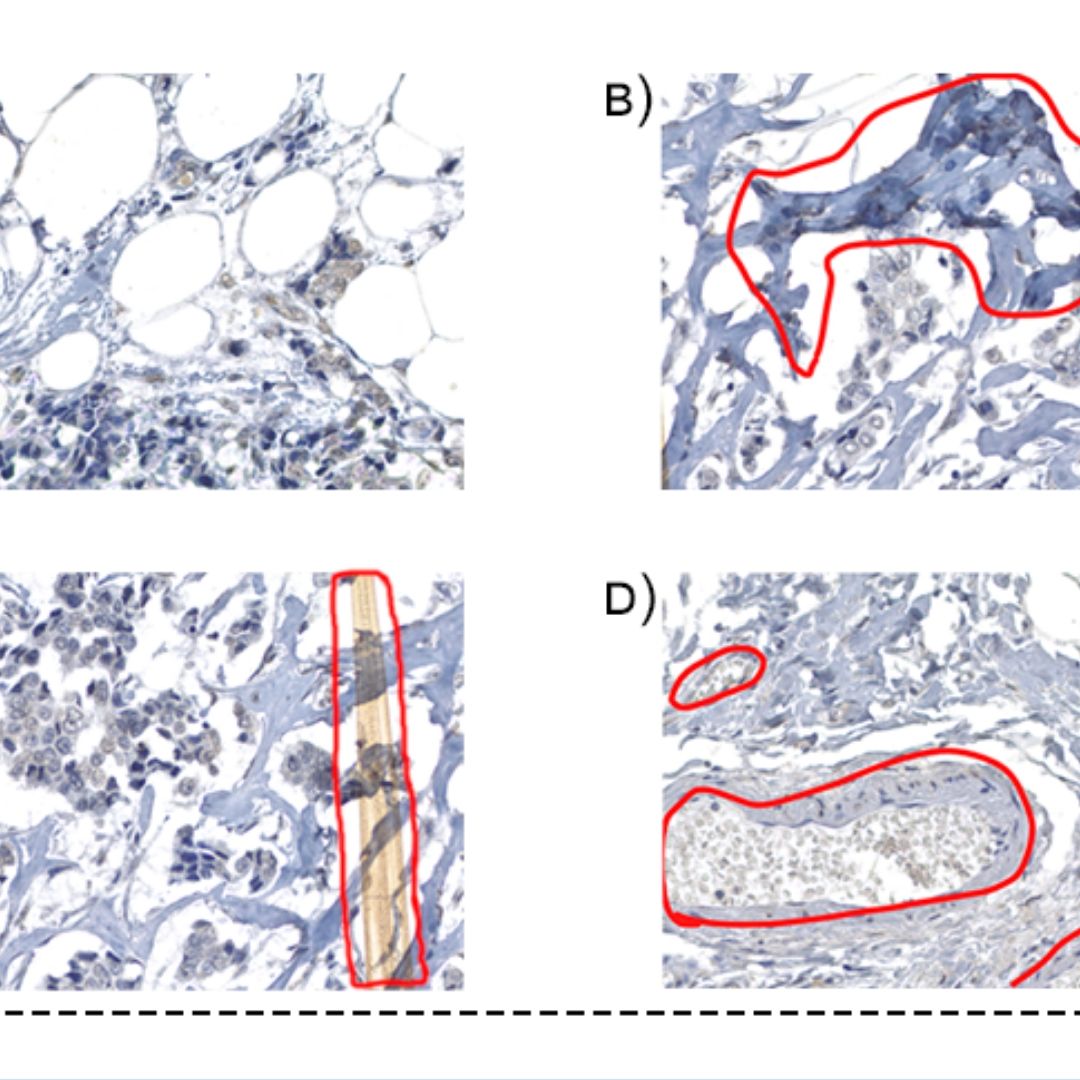 Classificação da qualidade de biópsia de mama usando redes neurais